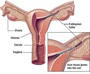 essure_utero