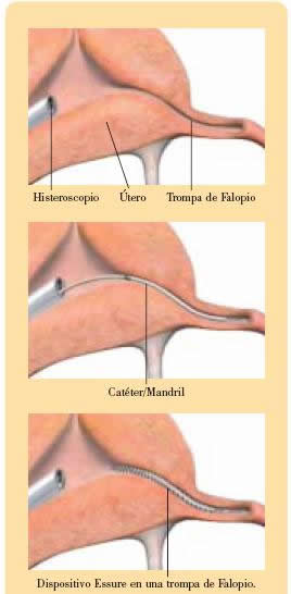 Procedimiento