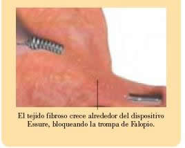 ProcedimientoI